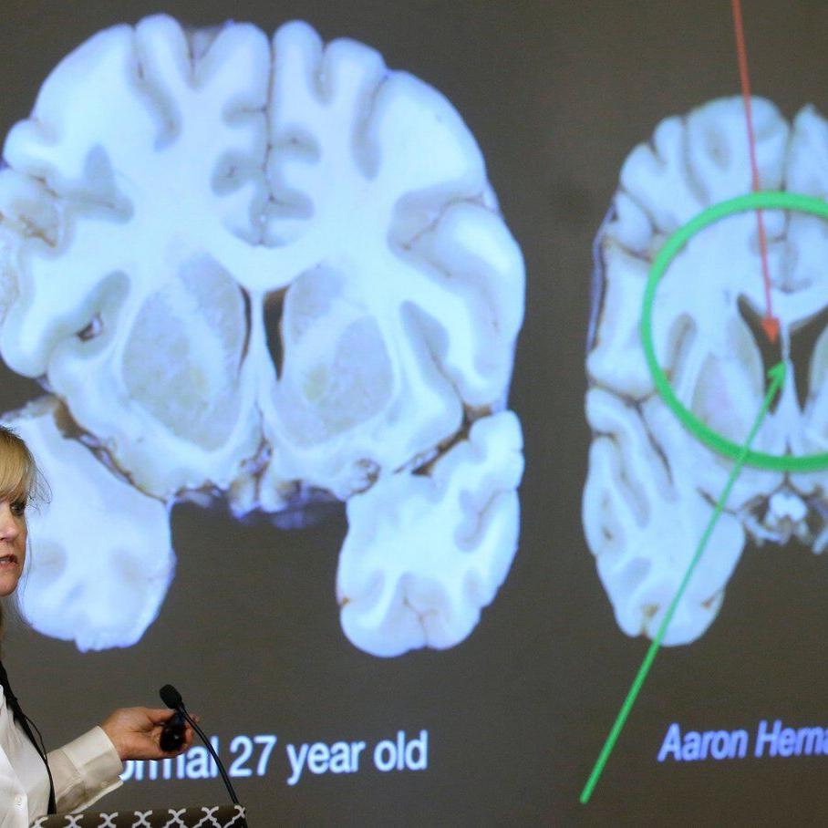 Here's what to know about CTE, the brain disease the NYC shooter blamed for his mental health issues